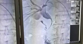 六安专业肾结石医院,六安治疗肾结石哪家医院好